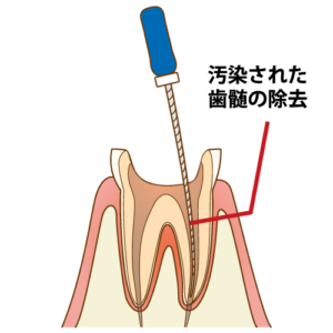 根管治療