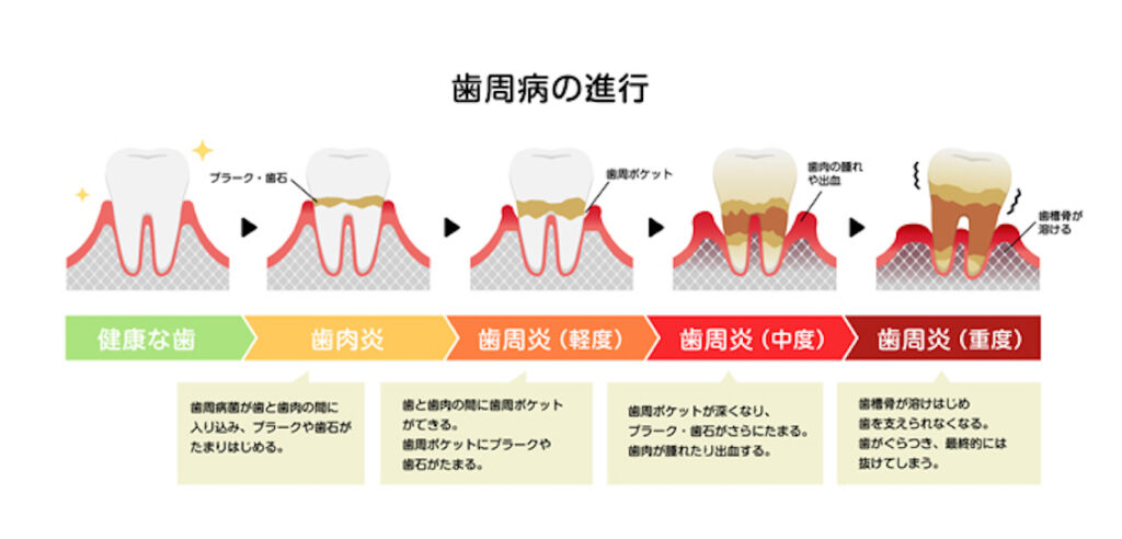歯周病の重症度