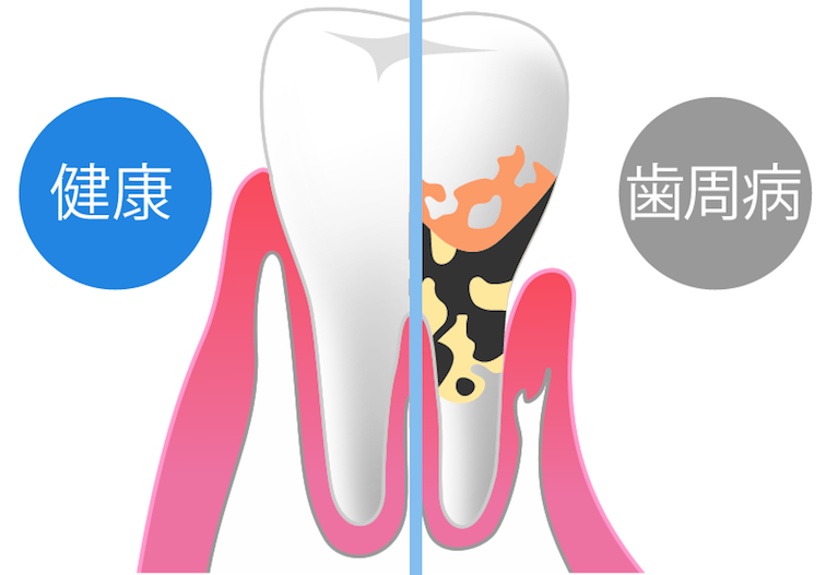 歯周病について